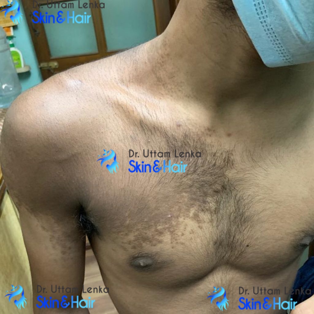 Becker’s Nevus