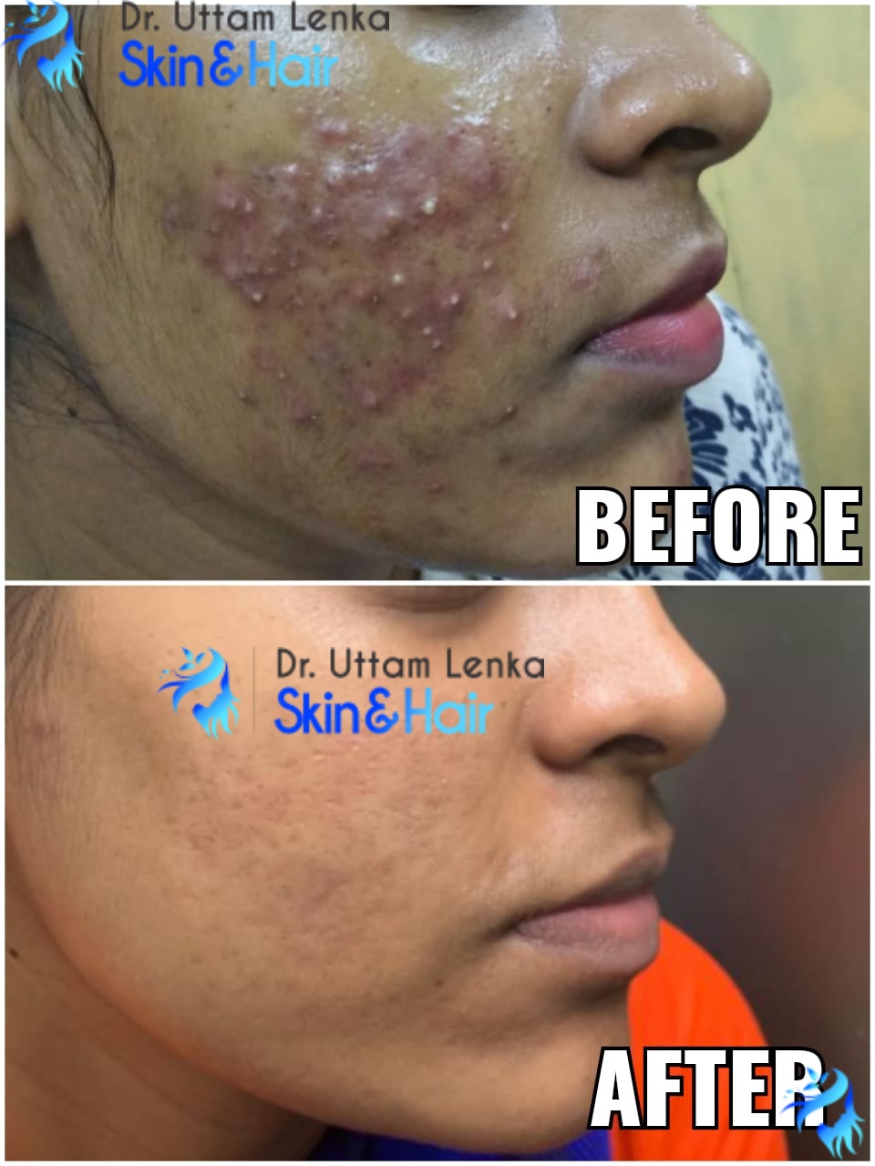 Pimples