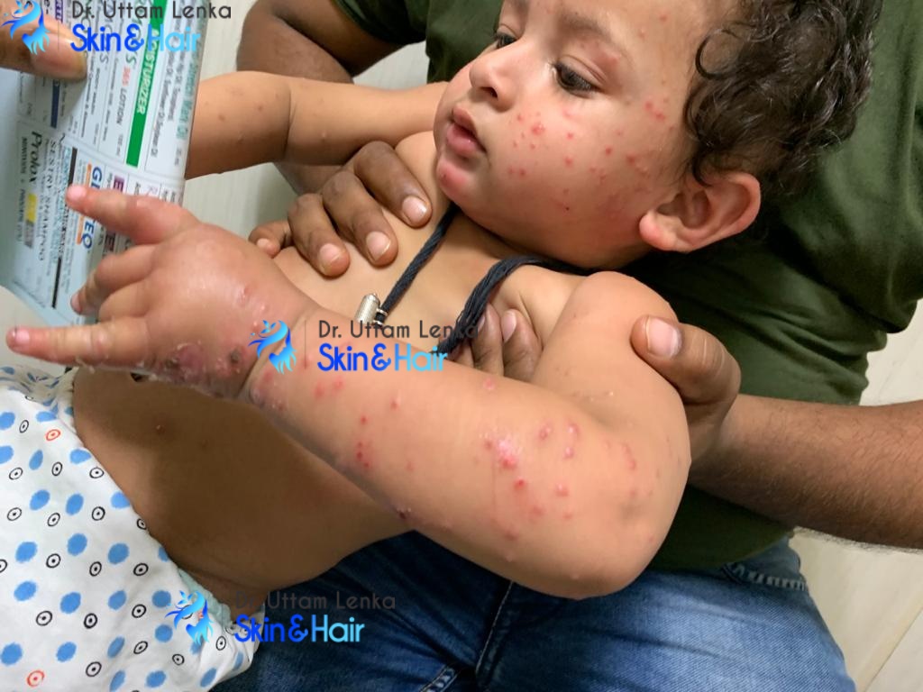 Insect bite allergy in small children