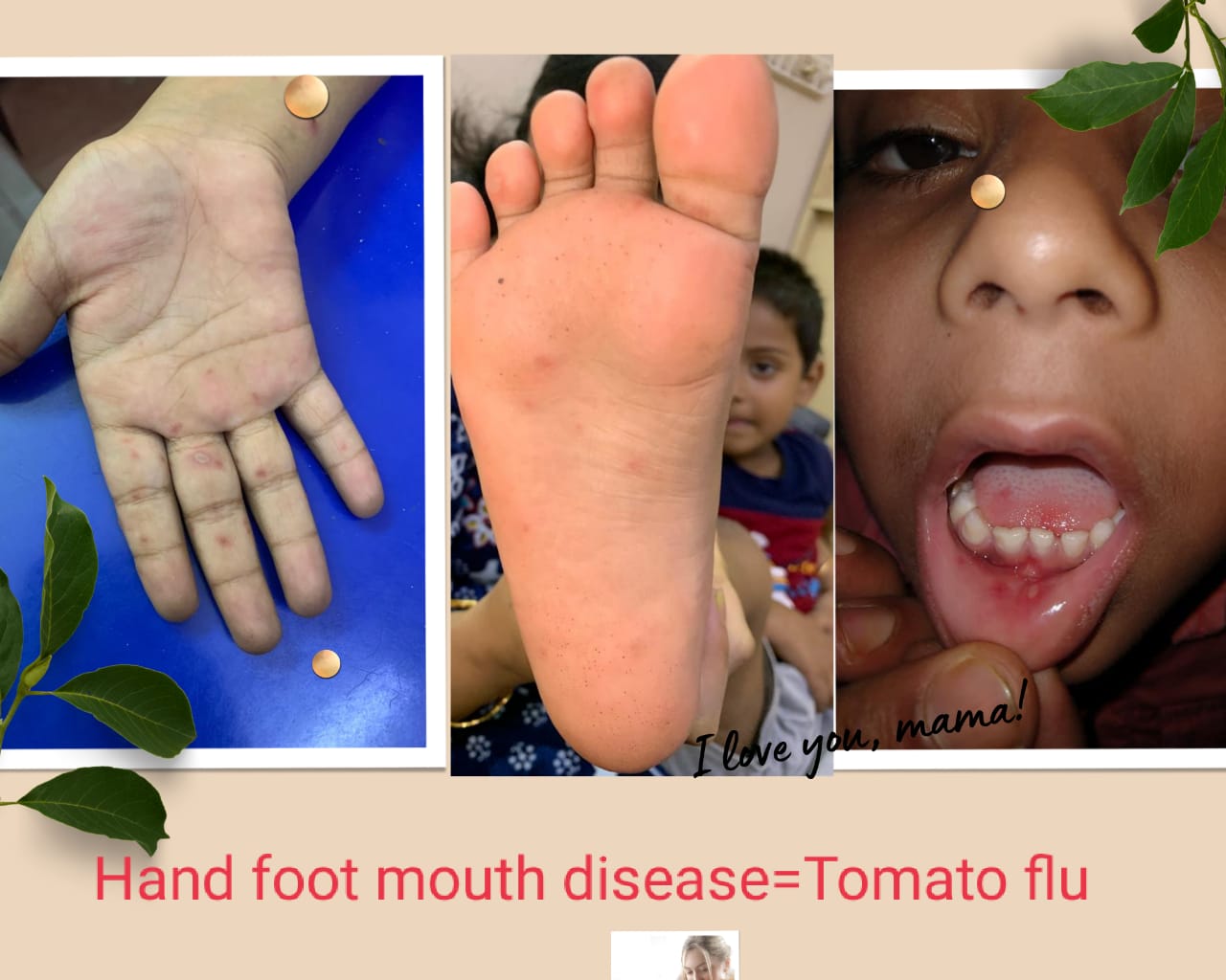 Tomato Flu