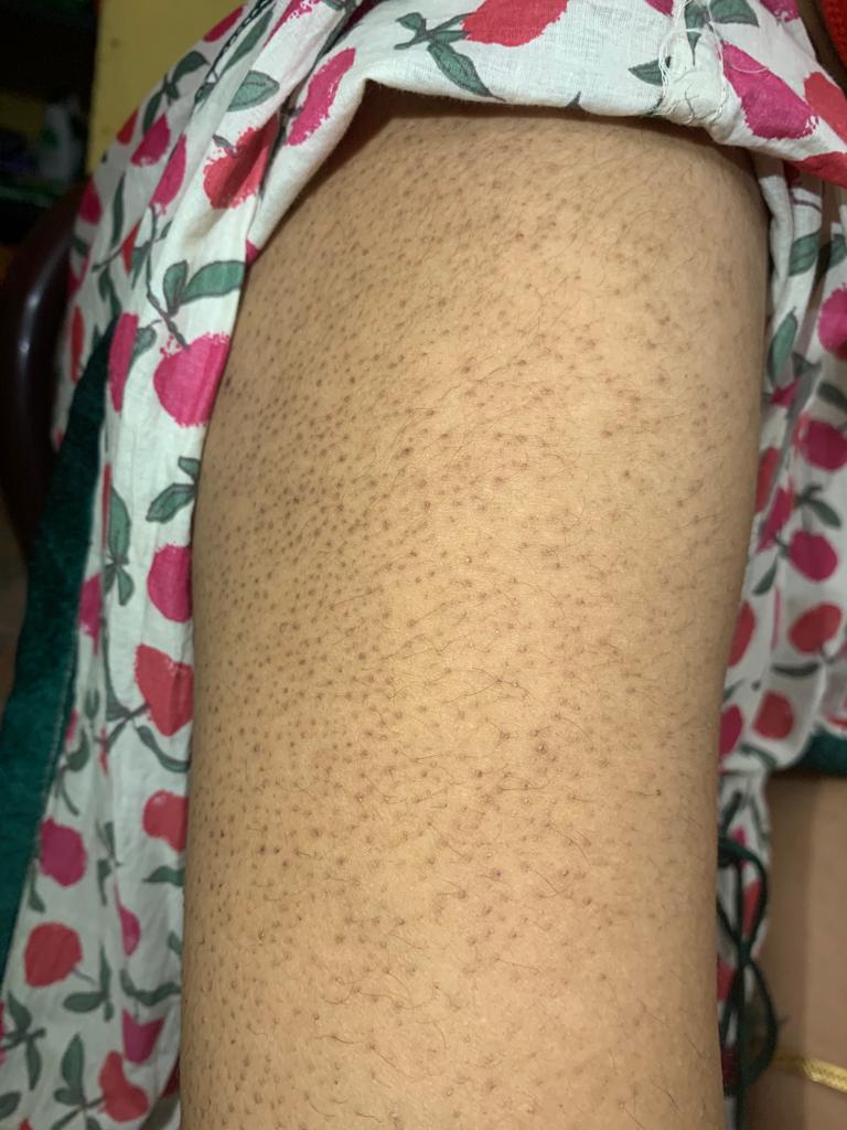 KERATOSIS PILARIS / CHICKEN SKIN